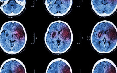 Study points to rising risk factors for stroke