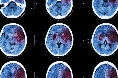 Study points to rising risk factors for stroke